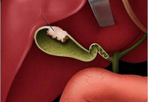 Sỏi túi mật có thể gây ung thư túi mật được không?